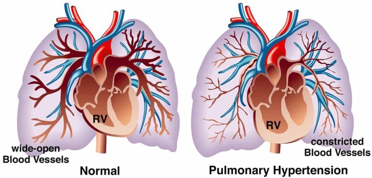 Unlocking Ancient Wisdom: Ayurvedic Treatments for Pulmonary Arterial Hypertension